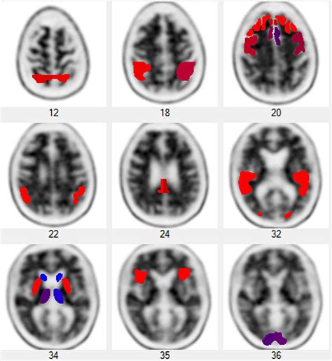 Amyloid Pet Scan Of The Brain Positive Photograph By Steven Needell