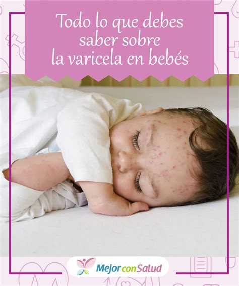 Todo Lo Que Debes Saber Sobre La Varicela En Beb S Varicela Bebe Salud