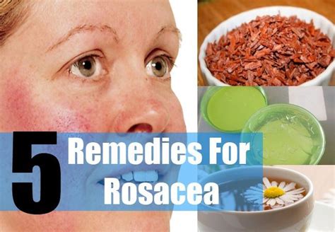 5 Remedies For Rosacea Natural Treatments Natural Remedies Remedies