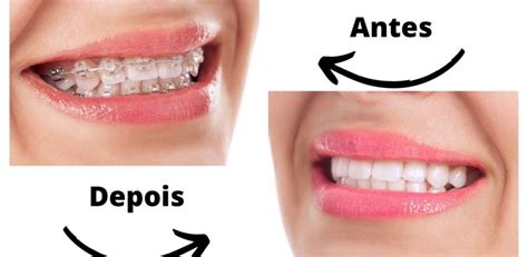 Aparelho ortodôntico antes e depois confira o resultado