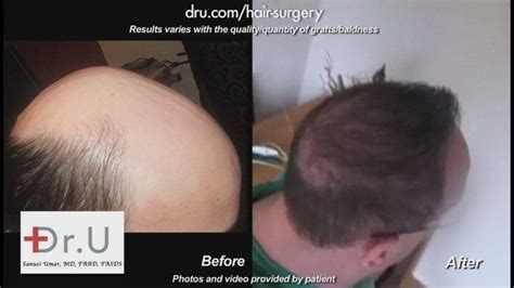 Patient Results Norwood 6 7 In Los Angeles Dr U Hair And Skin Clinic