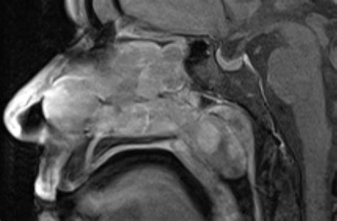 Sinonasal Polyposis Image