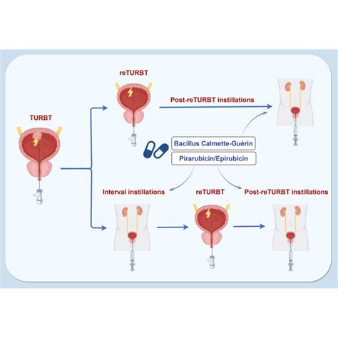 Intravesical Therapy For Bladder Cancer