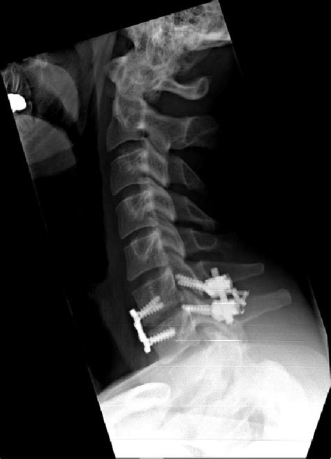 Radiograph after posterior fusion at C6-C7. | Download Scientific Diagram