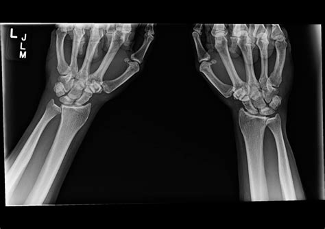 Orthodx Scapholunate Ligament Injury Clinical Advisor