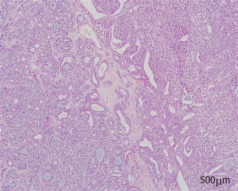 Microscopic Examination Of The Resected Specimen Showing A Biphasic