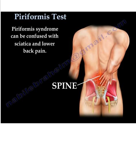 Piriformis Syndrome In Piriformis Syndrome Piriformis Human The Best