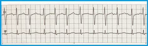 Atrial Fibrillation Ekg Rhythm Strips