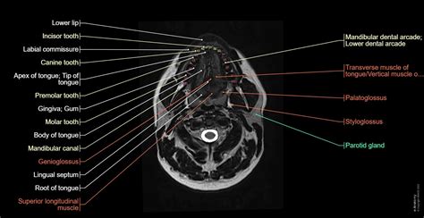 Mri Of Head And Neck