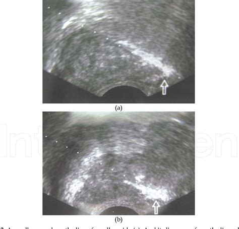 Figure 2 From Technical Advices For Prostate Needle Biopsy Under Transrectal Ultrasound Guidance