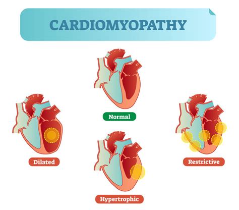 What is Cardiomyopathy, Symptoms, And Treatment? - Pulse Cardiology