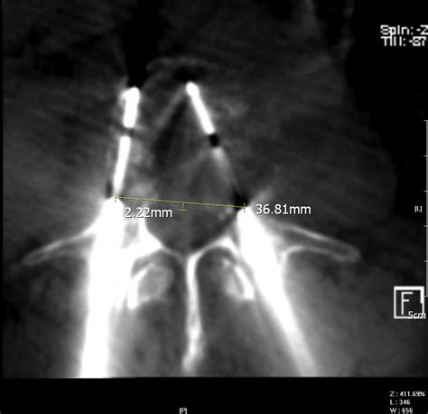 Bipolar Radiofrequency Ablation Of Spinal Tumors Predictability