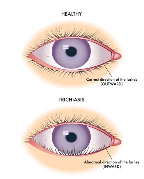 Ingrown Eyelash Causes Symptoms And Treatment