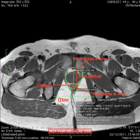 Mri Anatomy Of Pelvic Floor Muscles