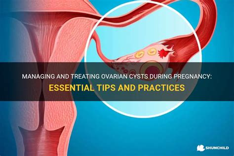 Managing And Treating Ovarian Cysts During Pregnancy Essential Tips