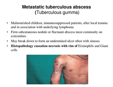 Cutaneous Tuberculosis