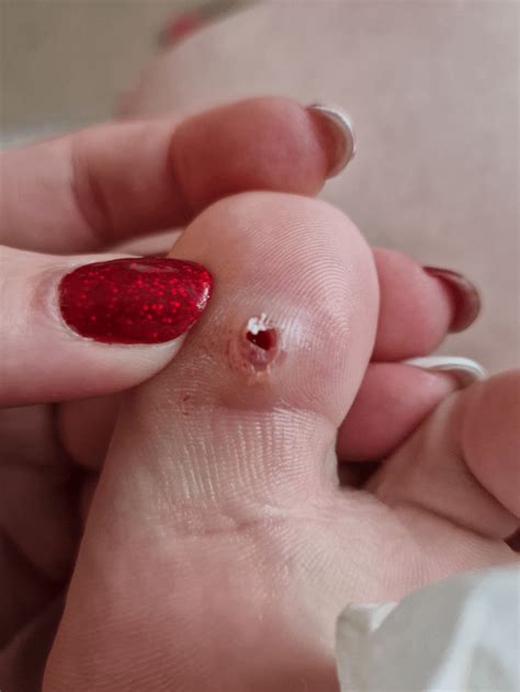 Just Popped A Cyst Sac Out The Bottom Of My Toe Rpopping