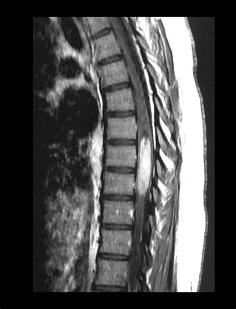 Thoracic Spinal Cord Ependymoma MRI Bild Kaufen 12642159 Science