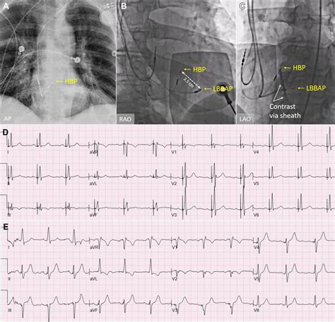 A Chest Radiograph Showing A Dual Chamber Pacemaker With A His Bundle