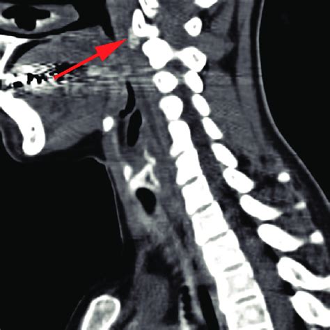 Sagittal Contrast Enhanced Computed Tomography Scan Of Neck Figure 2