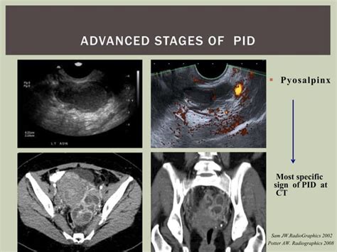 Acute Female Pelvic Infection Esur Congress Pptx