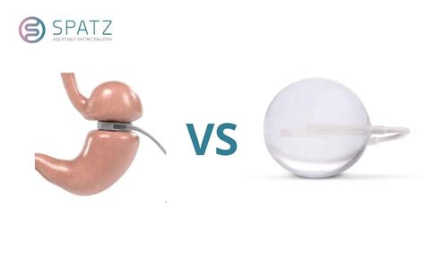 Gastric Balloon Vs Gastric Band Weight Loss Spatz