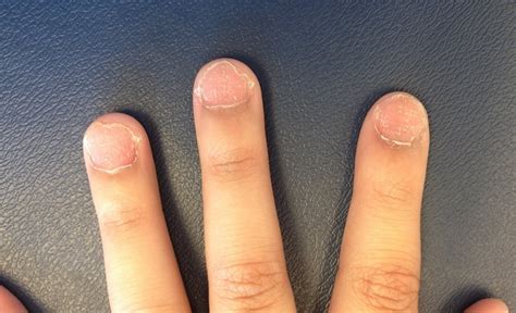 Rough Dry Fingernails