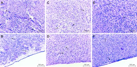 histology of glioblastoma multiforme tumor cultured on chorioallantoic ...