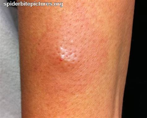 Brown Recluse Spider Bite Stages