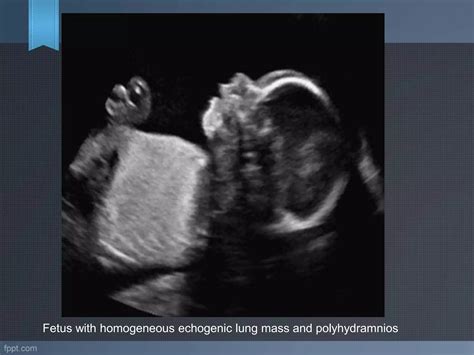 Ultrasound Evaluation Of Fetal Thorax Ppt