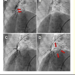 Representative Angiography In Balloon Pulmonary Angioplasty BPA In A