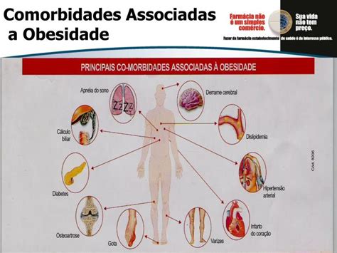 PPT Dislipidemia e Obesidade na Síndrome Metabólica PowerPoint