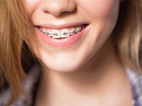 What Is The Best Type Of Braces