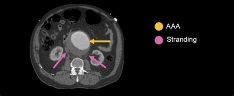 Abdominal Ct Phases • Litfl • Radiology Library