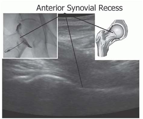 Ultrasound Guided Intra Articular Hip Injection Anesthesia Key