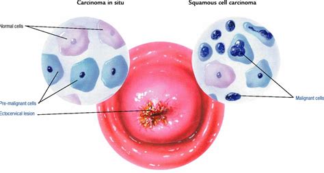 Cervical Cancer