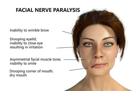 Bell S Palsy Natural Treatment Overland Park Acupuncturist