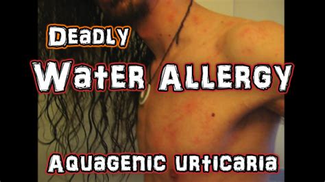 I Have An Extremely Rare Allergy To Water Aquagenic Urticaria The