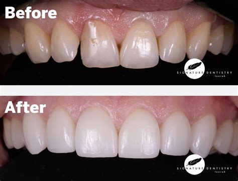 Veneers Before and After By Dr Kasen