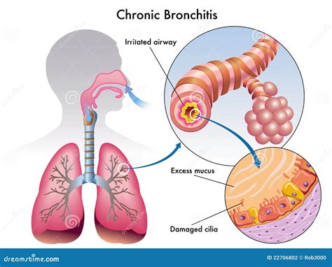 Chronic Bronchitis Stock Photography Image 22706802
