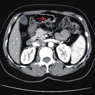 Abdominal Contrast Enhanced Computed Tomography Showed The High Density