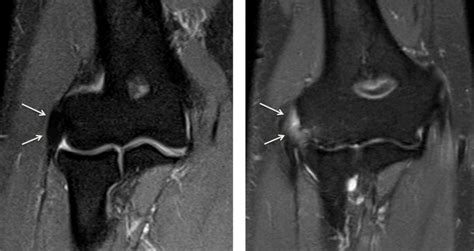 Tennis Elbow — Joseph J Schreiber Md