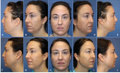 Rejuvenation Of The Midface Rejuvenation Resource