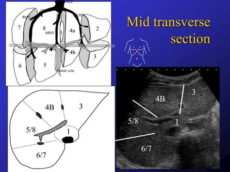 Liver Segments On Ultrasound Ppt