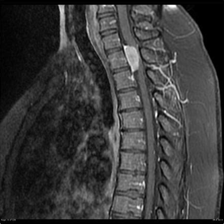 Spinal Meningioma Radiology Reference Article Radiopaedia Org