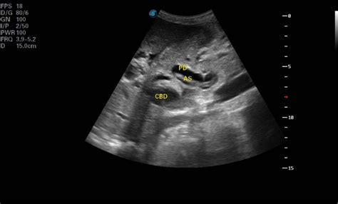 Dilated Common Bile Duct Cbd And Pancreatic Duct Pd And Linear Download Scientific Diagram