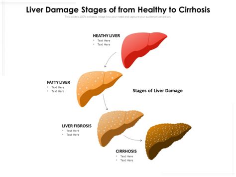 Liver Damage Stages Of From Healthy To Cirrhosis Ppt Powerpoint Presentation File Infographic