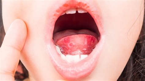 16 Signs And Symptoms Of A Streptococcal Throat Strep Throat