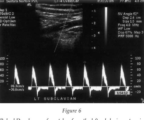 Figure From Pan Diastolic Flow Reversal In The Subclavian Artery An