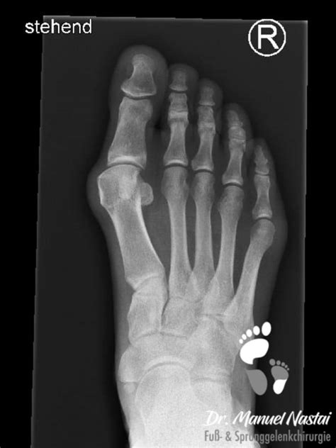 Minimalinvasive Hallux Valgus Op Dr Medic Manuel Nastai